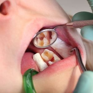 Child tooth fillings