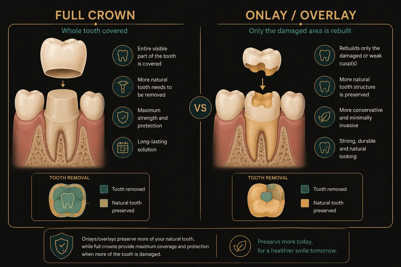 E.max onlay rebuilding part of a tooth with minimal tooth reduction versus a full crown