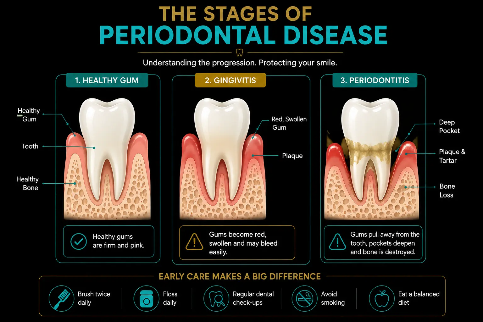 Diagram of gum disease stages from healthy gums to periodontitis with bone loss