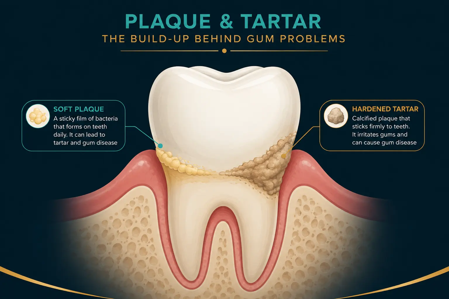 Diagram showing plaque hardening into tartar along the gum line