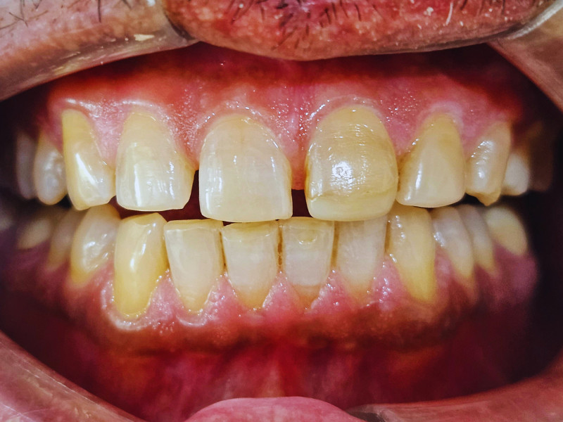 Before veneers smile makeover at Pristine Dental, Chandigarh