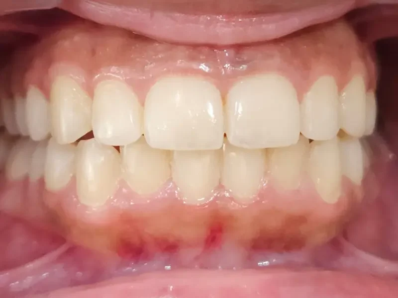 Before teeth whitening at Pristine Dental, Chandigarh