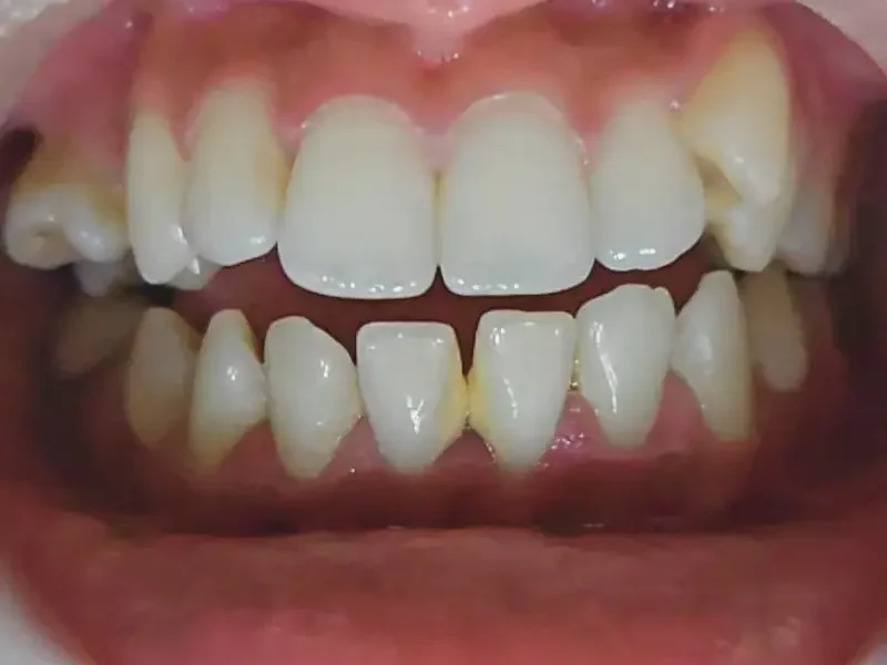 Intraoral view of a TMJ (jaw joint) patient at Pristine Dental, Chandigarh