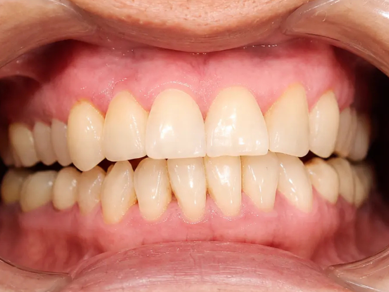 After Dental Implants at Pristine Dental, Chandigarh