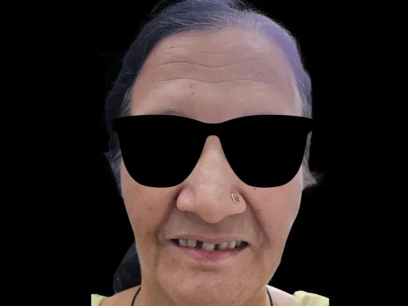 Complete smile rebuilt with full-mouth dental implants at Pristine Dental, Chandigarh