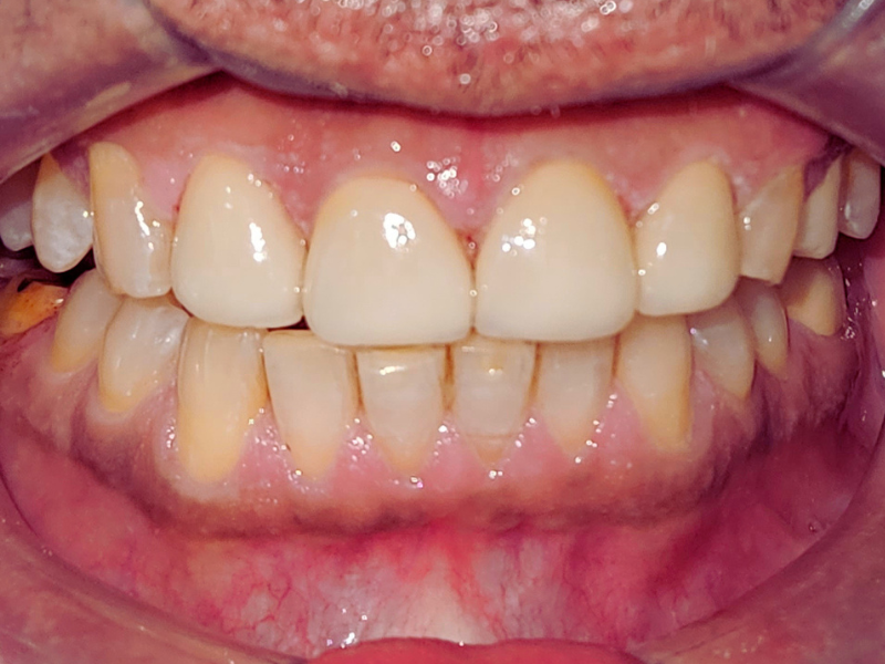 After veneers smile makeover at Pristine Dental, Chandigarh