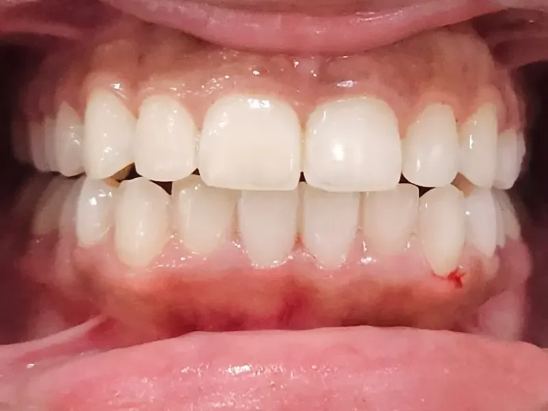 After teeth whitening at Pristine Dental, Chandigarh