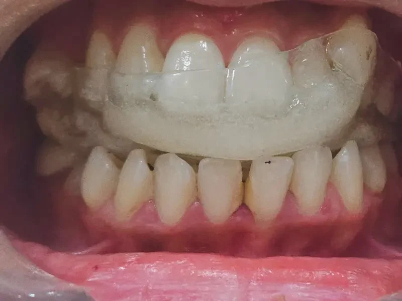 Custom TMJ splint in place during treatment at Pristine Dental, Chandigarh