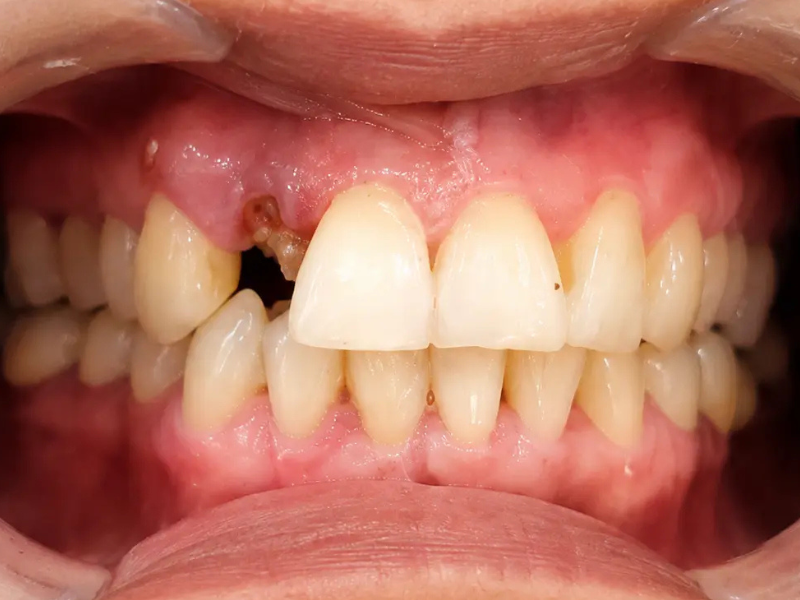 Before Dental Implants at Pristine Dental, Chandigarh