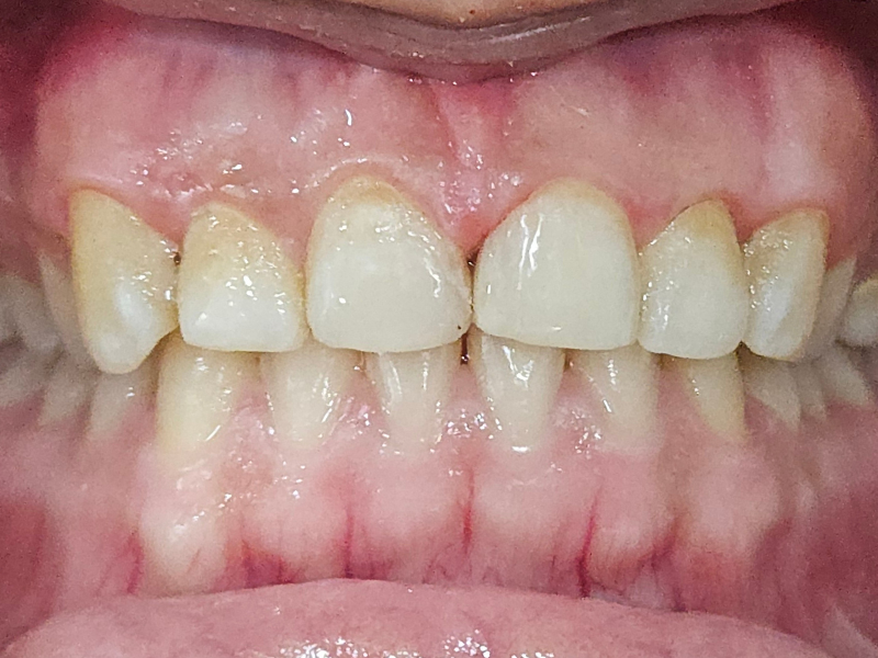 After composite bonding at Pristine Dental, Chandigarh