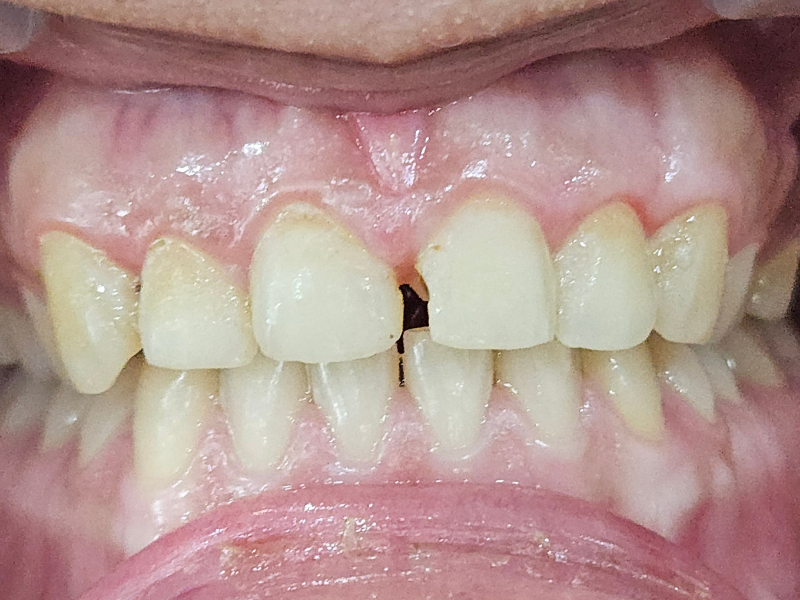 Before composite bonding at Pristine Dental, Chandigarh