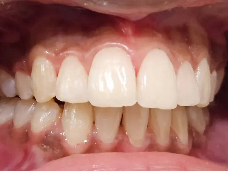 After composite bonding at Pristine Dental, Chandigarh