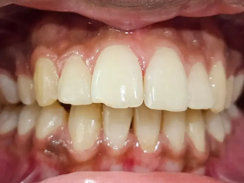 Before composite bonding at Pristine Dental, Chandigarh