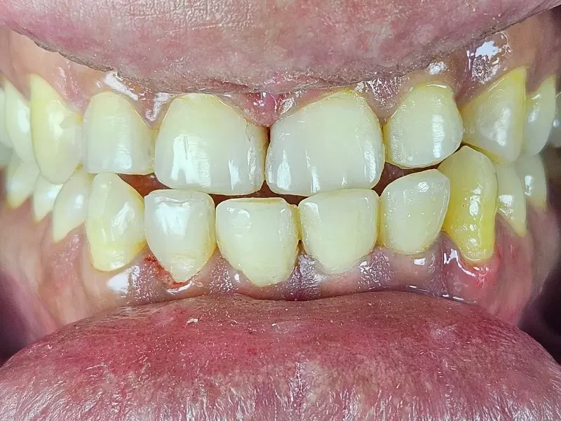 After composite bonding at Pristine Dental, Chandigarh
