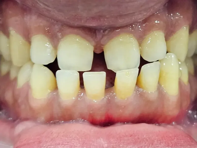 Before composite bonding at Pristine Dental, Chandigarh