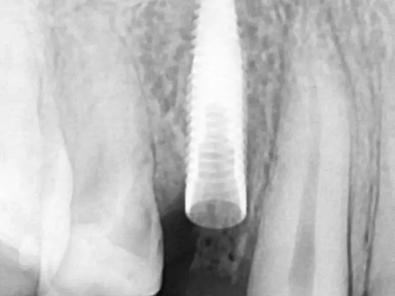 After dental implant at Pristine Dental, Chandigarh