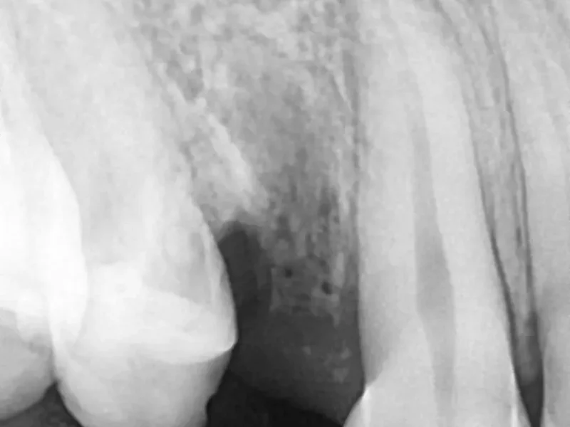 Before dental implant at Pristine Dental, Chandigarh