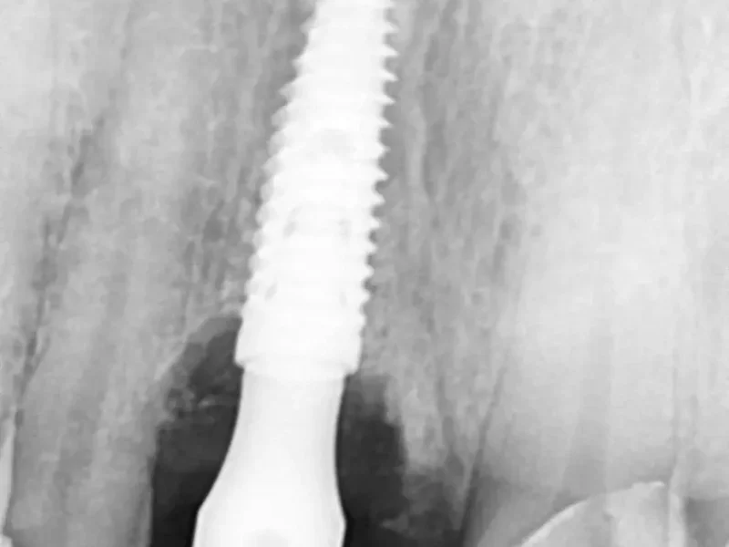 After dental implant at Pristine Dental, Chandigarh