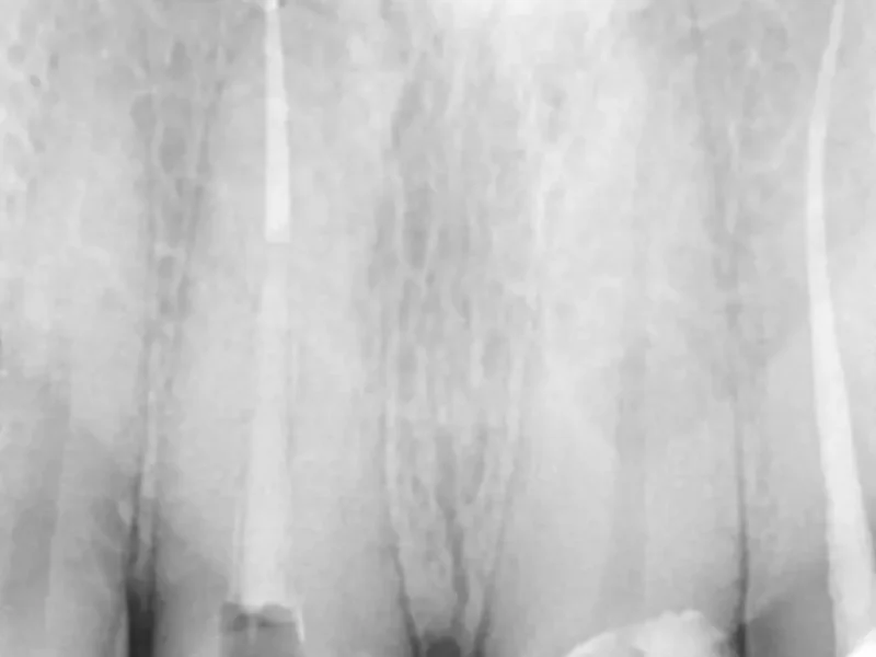 Before dental implant at Pristine Dental, Chandigarh