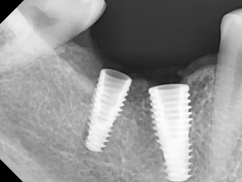 After dental implant at Pristine Dental, Chandigarh