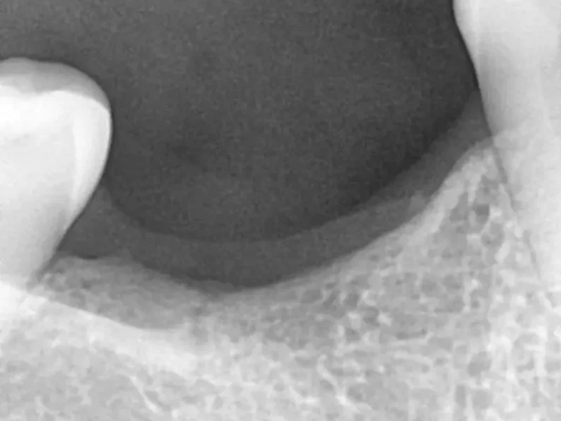 Before dental implant at Pristine Dental, Chandigarh
