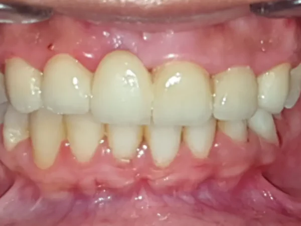 Tooth before and after root canal treatment and a protective crown at Pristine Dental