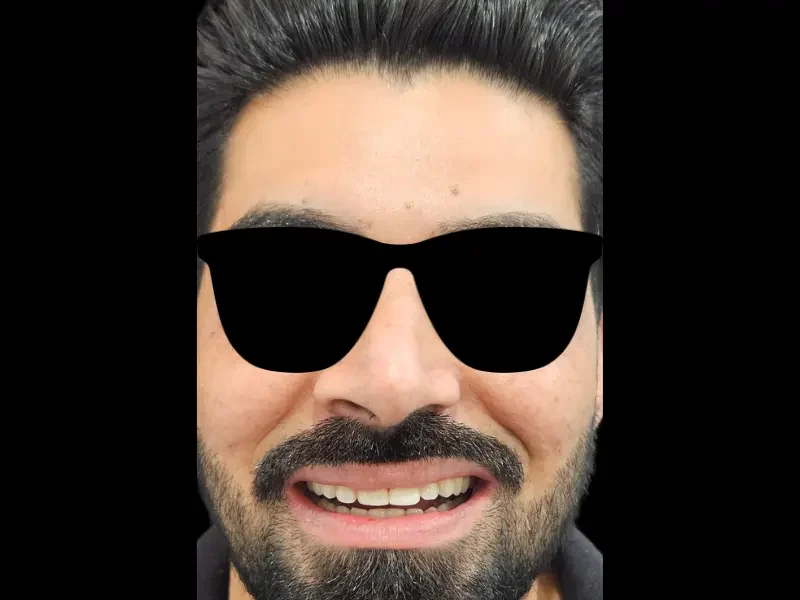 After veneers smile makeover at Pristine Dental, Chandigarh