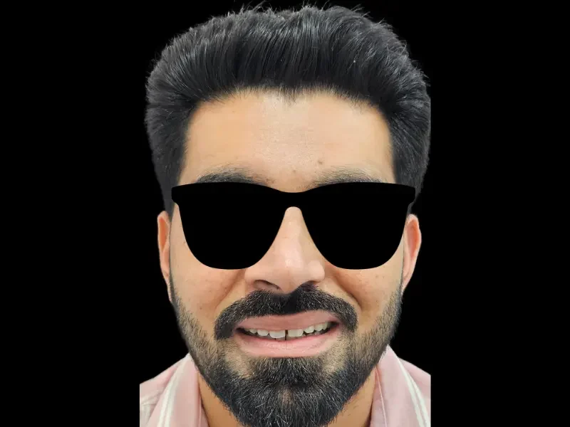 Before veneers smile makeover at Pristine Dental, Chandigarh